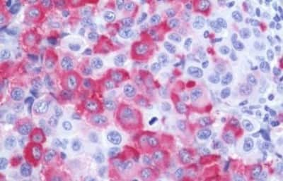 Immunohistochemistry-Paraffin: Wnt-10a Antibody [NBP3-14379] - Immunohistochemistry of formalin-fixed, paraffin-embedded human lymph node, melanoma,